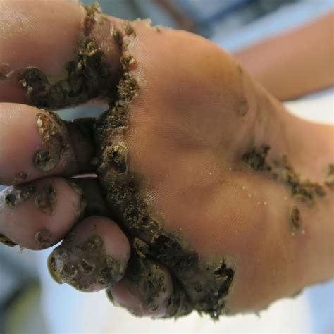 A Cluster Of Embedded Sand Fleas At The Sole Below The Toes And The