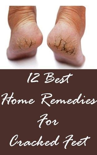 12 Best Home Remedies For Cracked Feet Home Remedies Natural Home Remedies Remedies