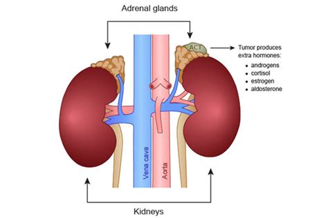 An Overview Of Adrenal Cancer Natstringersmusings