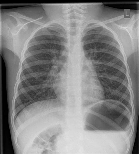Guidelines for the diagnosis and treatment of spontaneous pneumothorax. Thorax | OrthoRad