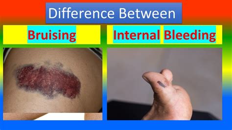 Difference Between Bruising And Internal Bleeding Youtube