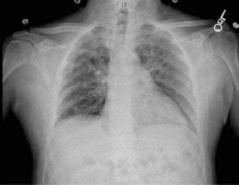 Cureus An Interesting Case Of Mixed Dust Pneumoconiosis With