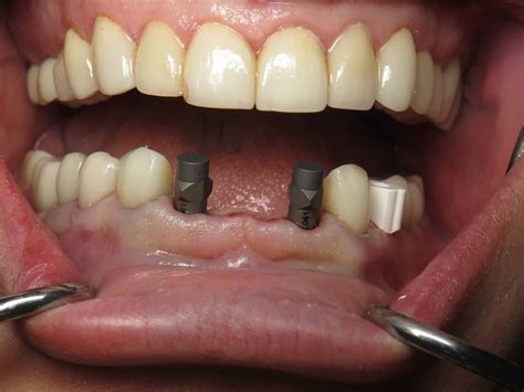 Immediate Implant Bridge Lower Jaw Front Teeth