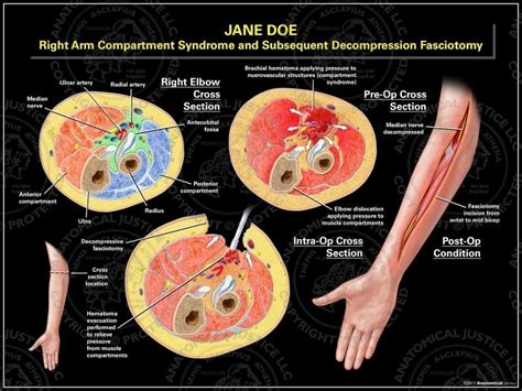 A case is reported of compartment syndrome of the whole arm occurring in a remote location and arrival at hospital 15 hours after injury with good results despite delayed late (>16 hours)fasciotomy was performed with retention of the upper arm, elbow and proximal forearm with good residual function. Right Arm Compartment Syndrome and Subsequent ...