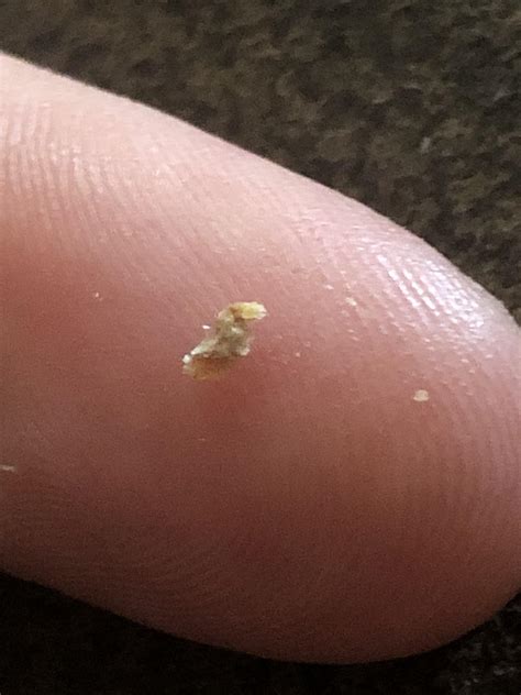 Every few months, a pore fills on my fiance’s head. I can usually pop