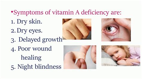 Vitamin A Deficiency Youtube
