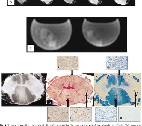 Figure 1 From Post Mortem High Resolution Mri Of The Spinal Cord In Multiple Sclerosis A