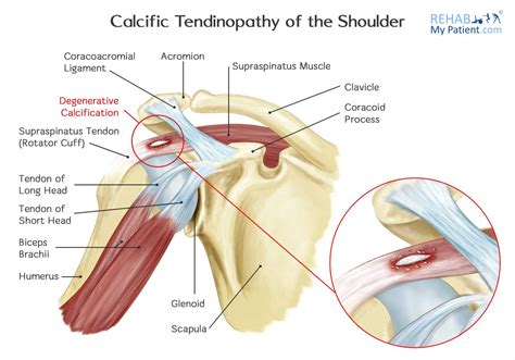 Shoulder Calcification