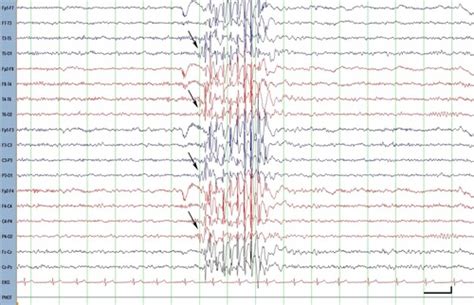 Eeg Syndromes Flashcards Quizlet