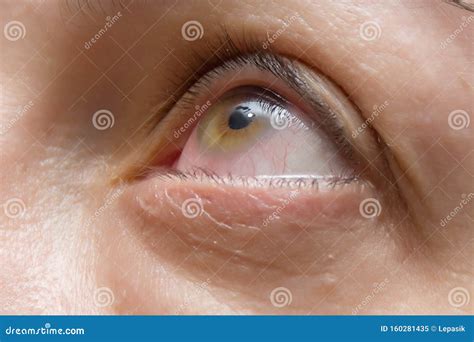 Inflammation And Redness Of The Eyes Eye Disease And Pupil Surgery