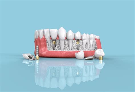 Can You Get Dental Implants For More Than One Missing Tooth Arc
