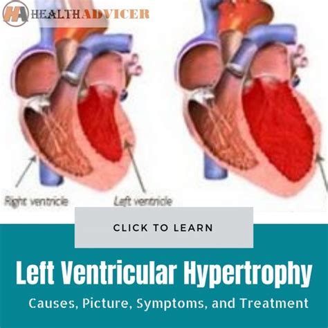 Left Ventricular Hypertrophy Causes Picture Symptoms And Treatment