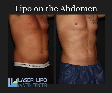 Medical Weight Loss With Liposuction In St Louis St Louis Laser