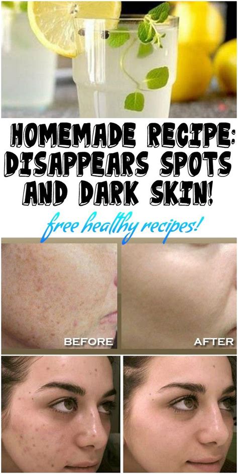 Homemade Recipe Disappears Spots And Dark Skin Health And Joy In 2019