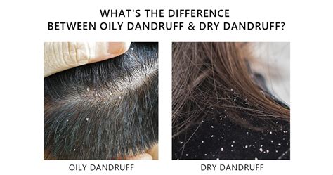 20 Dry Scalp Flakes Vs Dandruff Fashion Style