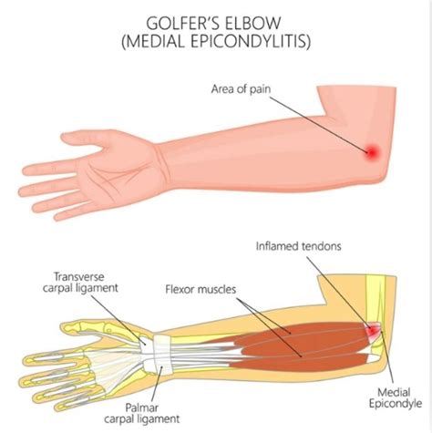Physical Solutions Elbow Pain Affecting Your Game Physical Solutions