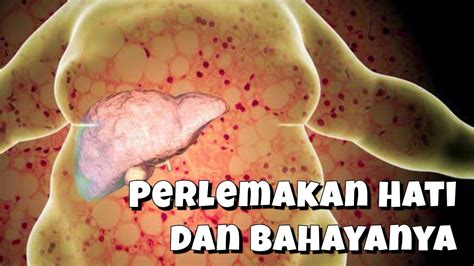 Perlemakan Hati Dan Bahayanya Youtube