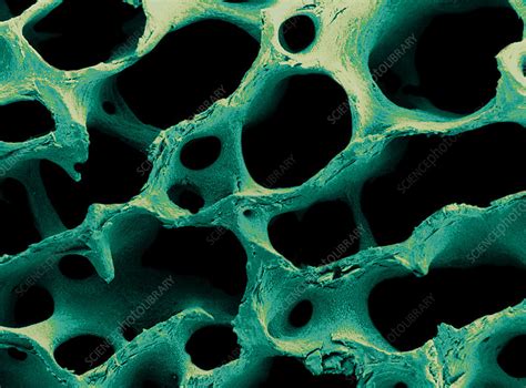 Coloured Sem Of Human Spongy Bone Stock Image P1050113 Science