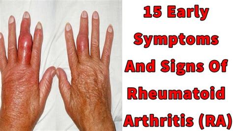 5 Rheumatoid Arthritis Symptoms And Signs Arthritis In The Si Joints
