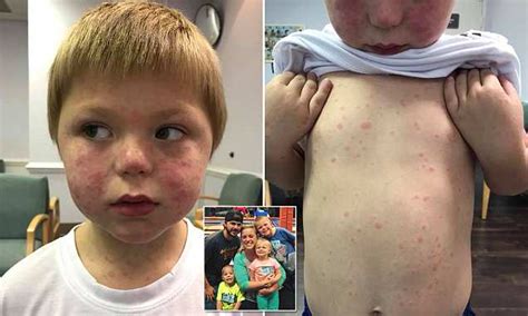 Five Year Old Boys Rash Turned Out To Be Rare Disease From A Tick Bite