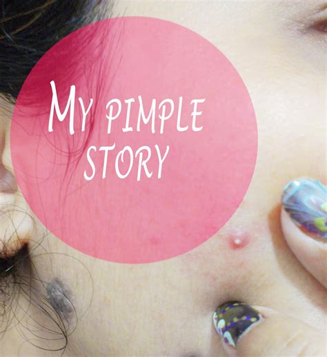 A Pimple Makes My Life Unpleasant Beauty And Lifestyle Mantra India