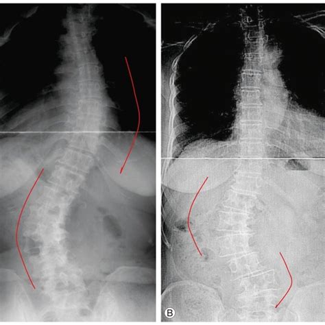 Comparison Of Adult Idiopathic Scoliosis With Adult Degenerative