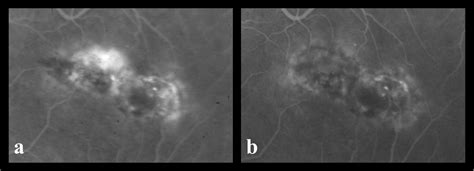 Photodynamic Therapy And Intravitreal Triamcinolone For A Subretinal