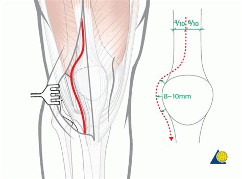 Synovectomy Knee Indications And Procedure Steps Bone And Spine
