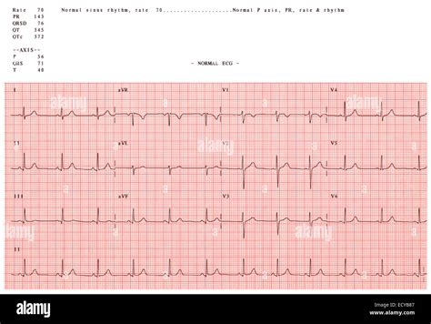 Normal Electrocardiogram Stock Photo 76818903 Alamy