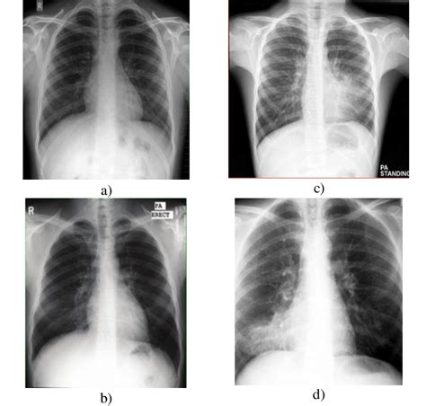 Present Some Samples Of Normal And Pneumonia Lung X Ray Images