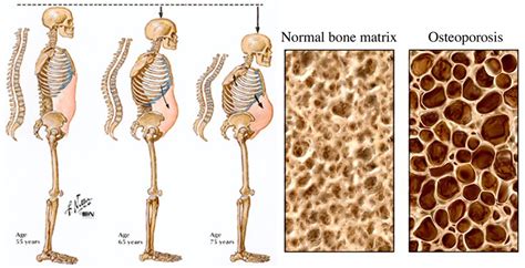 To compare biochemical variables, renal function and calcium and vitamin d intakes in euparathyroid and hyperparathyroid patients with. Osteoporosis - Causes, Risk Factors & Treatment, Symptoms ...