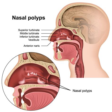 Nasal Polyps Colorado Allergy Asthma Centers P C