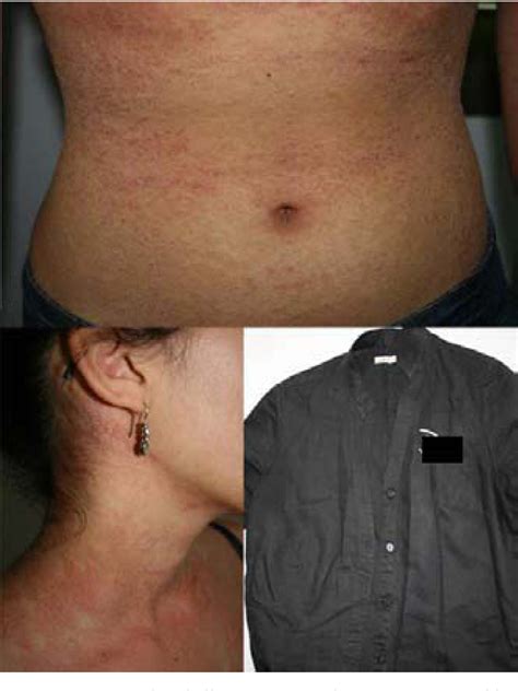 Figure 2 From Allergic Contact Dermatitis Caused By Formaldehyde And