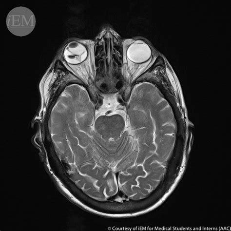 414 Retinal Detachment Mri Image Of Retinal Detachment Flickr