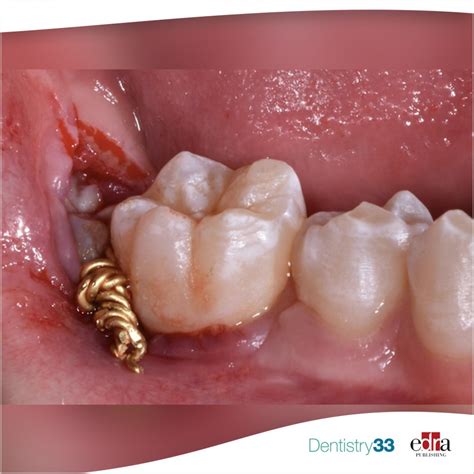 The Treatment Of Impacted Mandibular Second Molars Using Brass Wire A