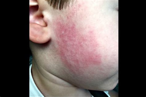 Case Study Sudden Blotchy Rash On Cheek Dermatology Advisor