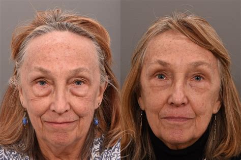 Eyelid Lift Before After Photos Patient Serving Rochester Syracuse Buffalo NY