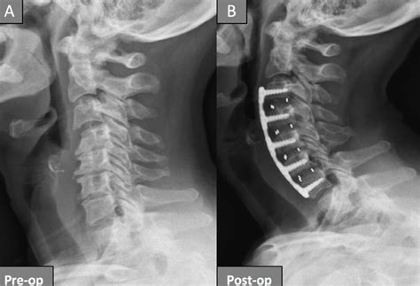 Cureus Kyphosis Correction In Patients Undergoing A Four Level