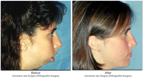 Before And After Jaw Surgery Dr Larry M Wolford Dmd