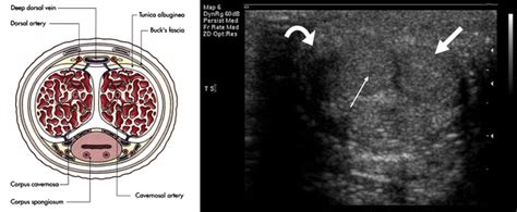 Erectile Dysfunction The Role Of Penile Doppler Ultrasound In