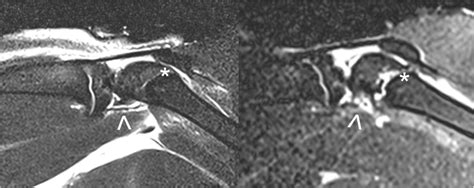 Mri Scans Of The Knee Joint Mri Proton Density And T2 Weighted Turbo