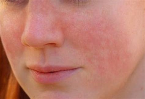 Lupus Rash Pictures Symptoms Causes Treatment 2018 Updated