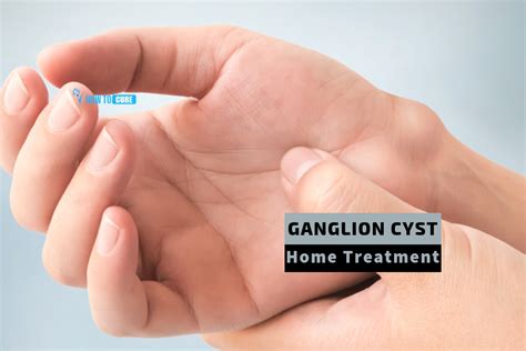 Top 5 Ganglion Cyst Home Treatments You Never Heard How To Cure