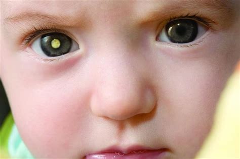 Childhood Eye Cancer Trust Study Highlights Rb Risks Optician