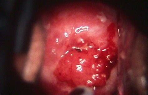 What does cervical cancer smell like. What Does most cancers Of Cervix seem like