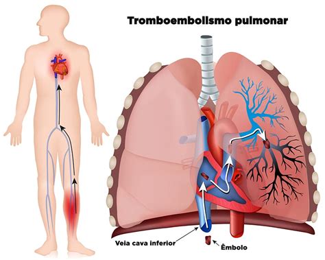 Trombosis Pulmonar Introduccion A La Embolia Pulmonar Thrombosis My