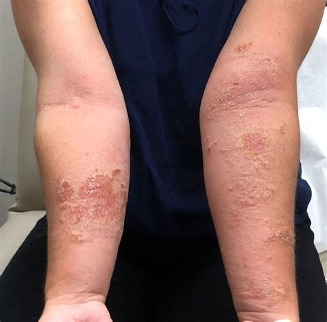 Acute allergic contact dermatitis caused by (a) topical herbal medicine for a sprained ankle (severe reaction), (b) fragrance in deodorant, and (c) adhesive tape used after abdominal hysterectomy. Allergic Contact Dermatitis | Pennsylvania Dermatology ...