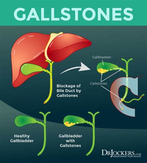 How To Beat Gallstones Naturally Gallstones Lower