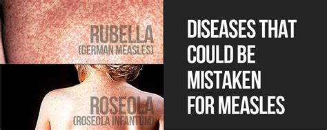 Can Adults Get Roseola Reviziongive