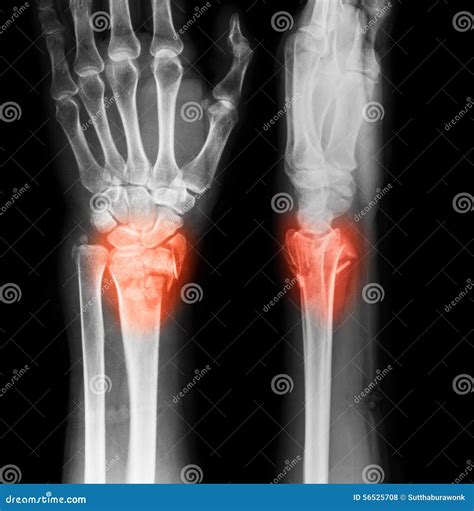 X Ray Image Of Wrist Joint Ap And Lateral View Stock Photo Image